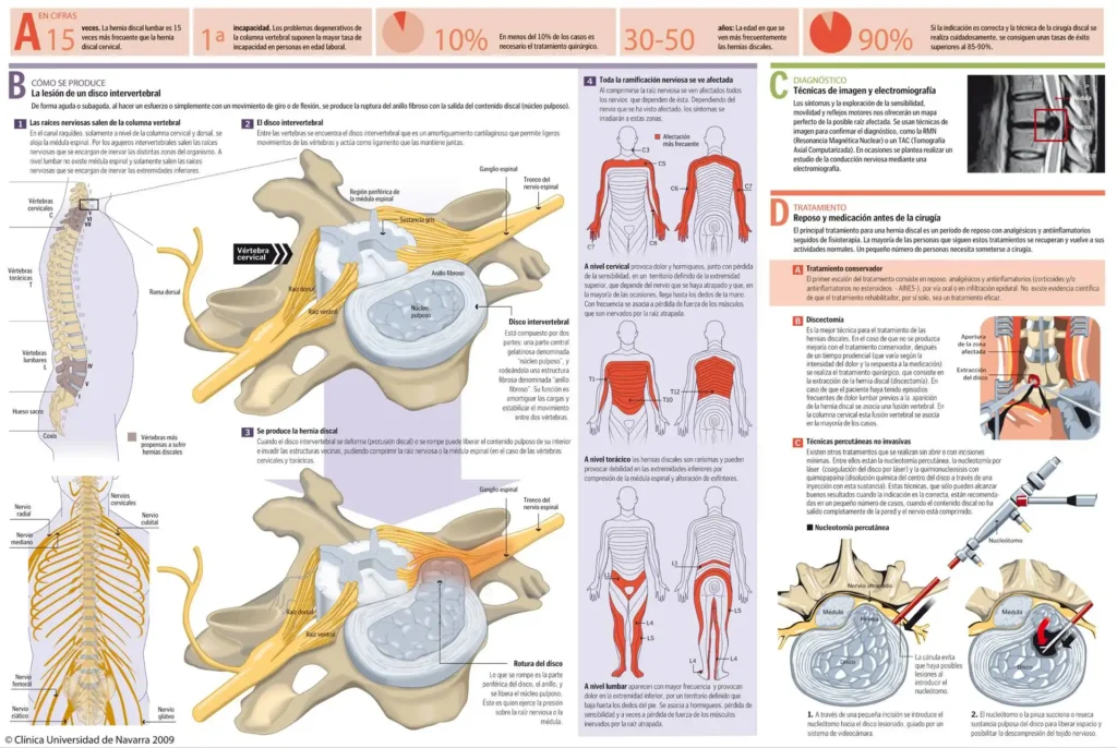 Hernias Discales: Causas, Síntomas y Opciones de Tratamiento