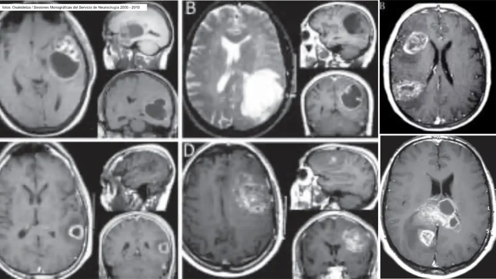 Desigualdad en el Acceso a Tratamientos para el Glioblastoma en Andalucía