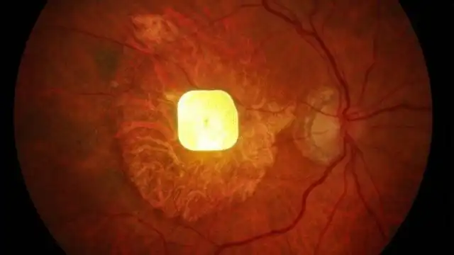 Innovación en la Visión: Un Chip que Transforma la Vida de Pacientes con Degeneración Macular