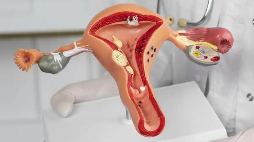 Endometriosis: Un Desafío Médico y Social para las Mujeres