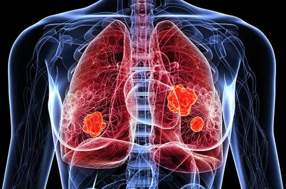 Nuevas Perspectivas en el Tratamiento del Cáncer de Pulmón: Un Avance Metabólico Revelador