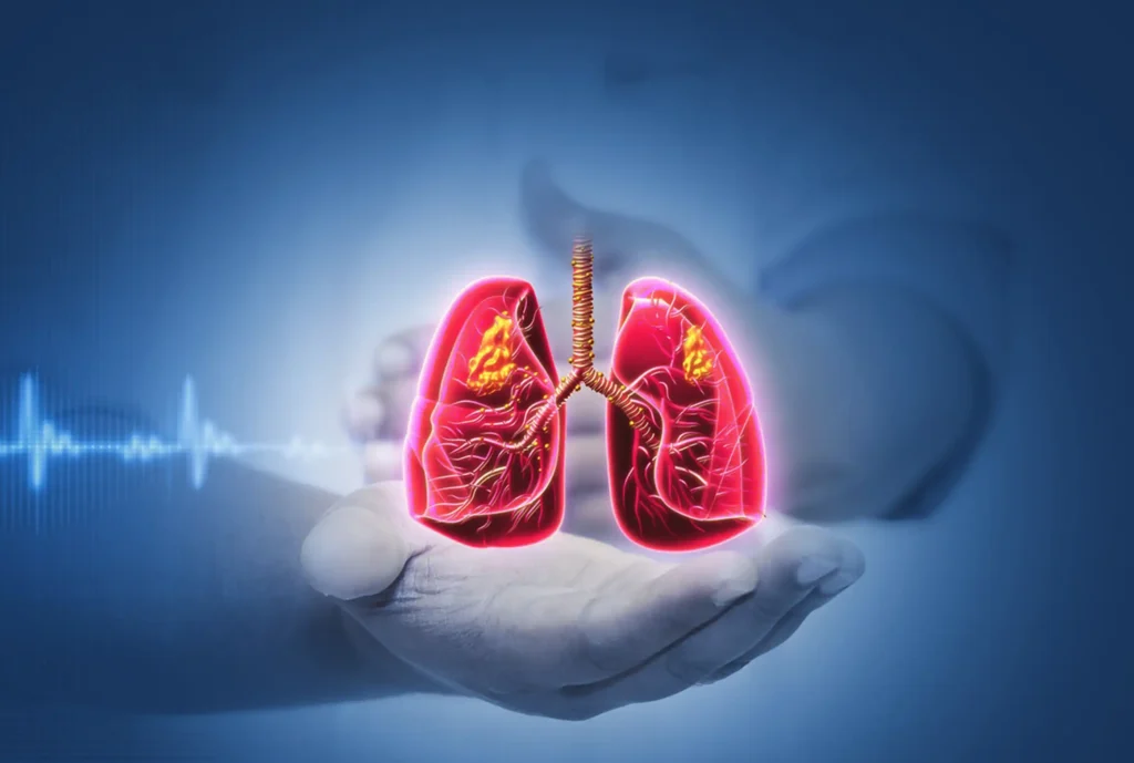 El Cáncer de Pulmón: Un Desafío Creciente en la Salud Pública
