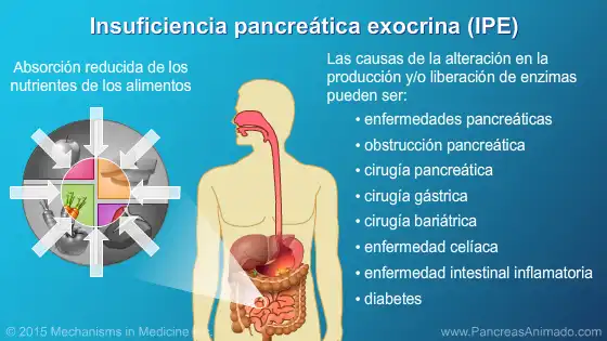 La Importancia de Detectar la Insuficiencia Pancreática a Tiempo