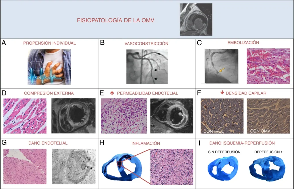Avances en la Detección Temprana del Daño Microvascular Post-Infarto
