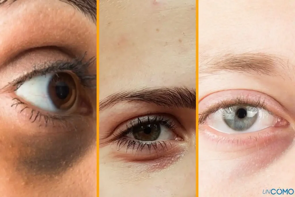 Descifrando las Ojeras: Lo Que Su Color Revela Sobre Tu Salud