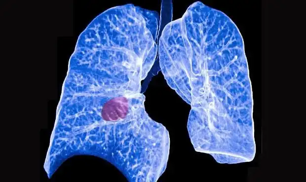 Nuevas Revelaciones sobre el Cáncer de Pulmón de Células Pequeñas: La Inflamación como Factor Clave