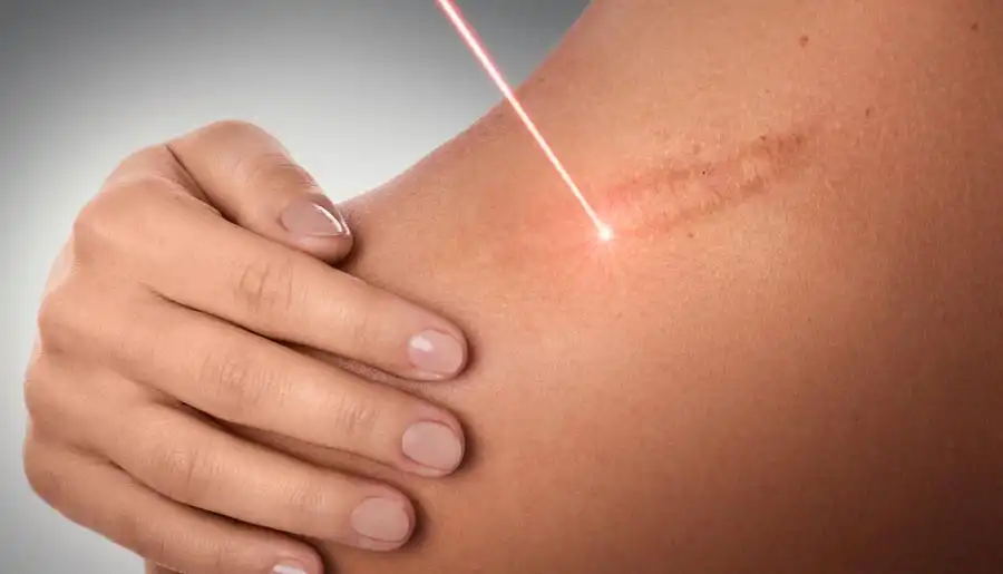 El Impacto del Láser Dermatológico en la Estética de la Piel