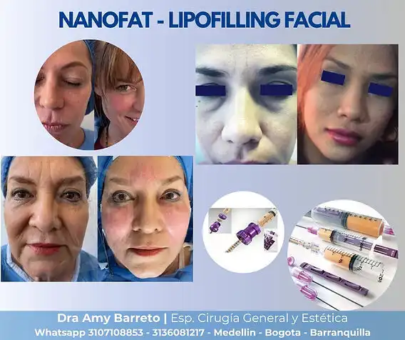 Transformación Facial: Comparativa entre Ácido Hialurónico y Lipolifting