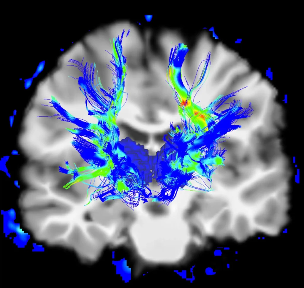 Nuevas Perspectivas en el Tratamiento del Parkinson: La Red Somatocognitiva como Clave