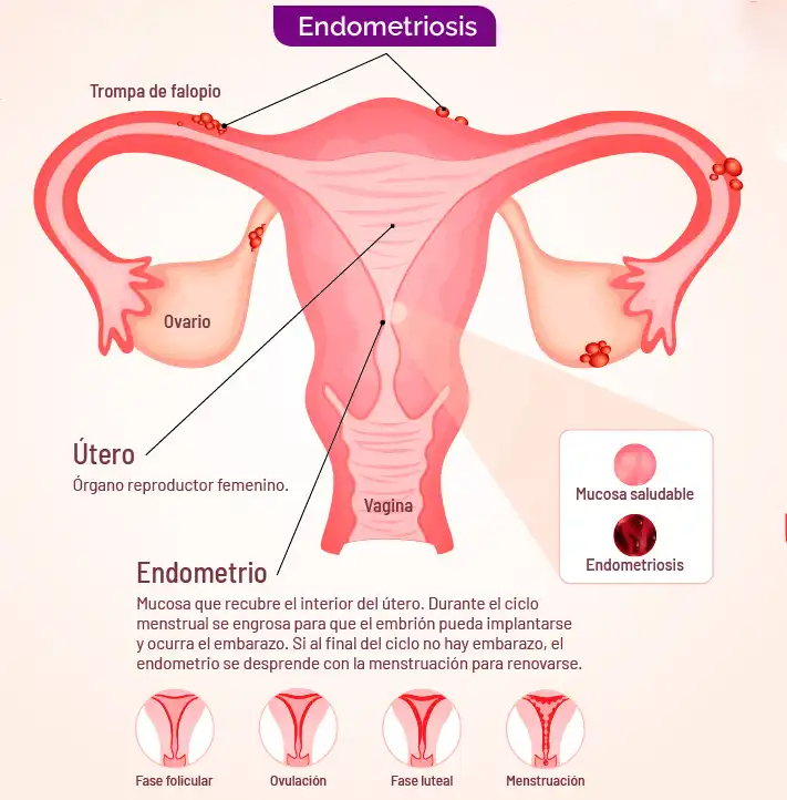 La Endometriosis: Un Problema de Salud Ignorado que Afecta a Millones de Mujeres