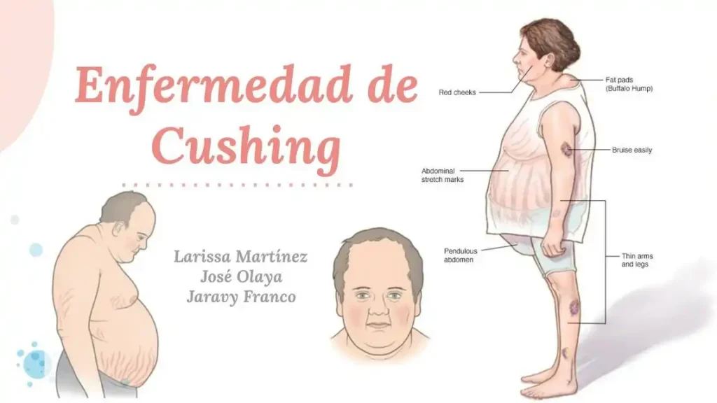 Síndrome de Cushing: síntomas, diagnóstico tardío y secuelas persistentes