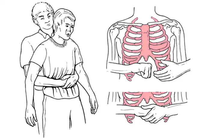 Maniobra de Heimlich en lactantes: cómo salvar una vida en parada respiratoria