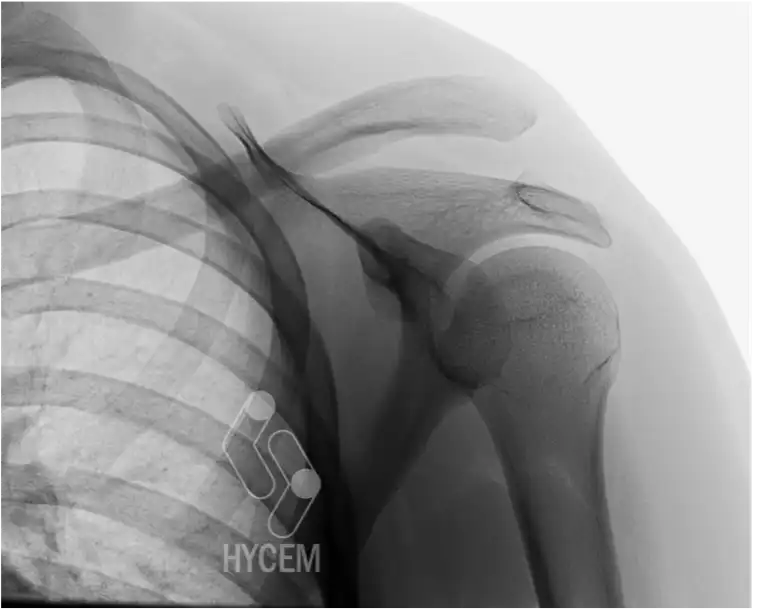 Luxación acromioclavicular severa: qué es y por qué requiere cirugía urgente