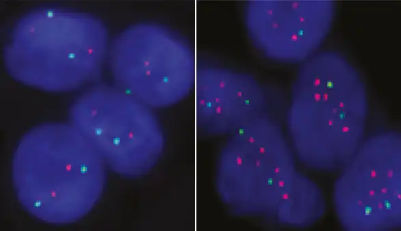 ¿Qué es el gen Prrx1 y cómo regula las metástasis en cáncer de mama?
