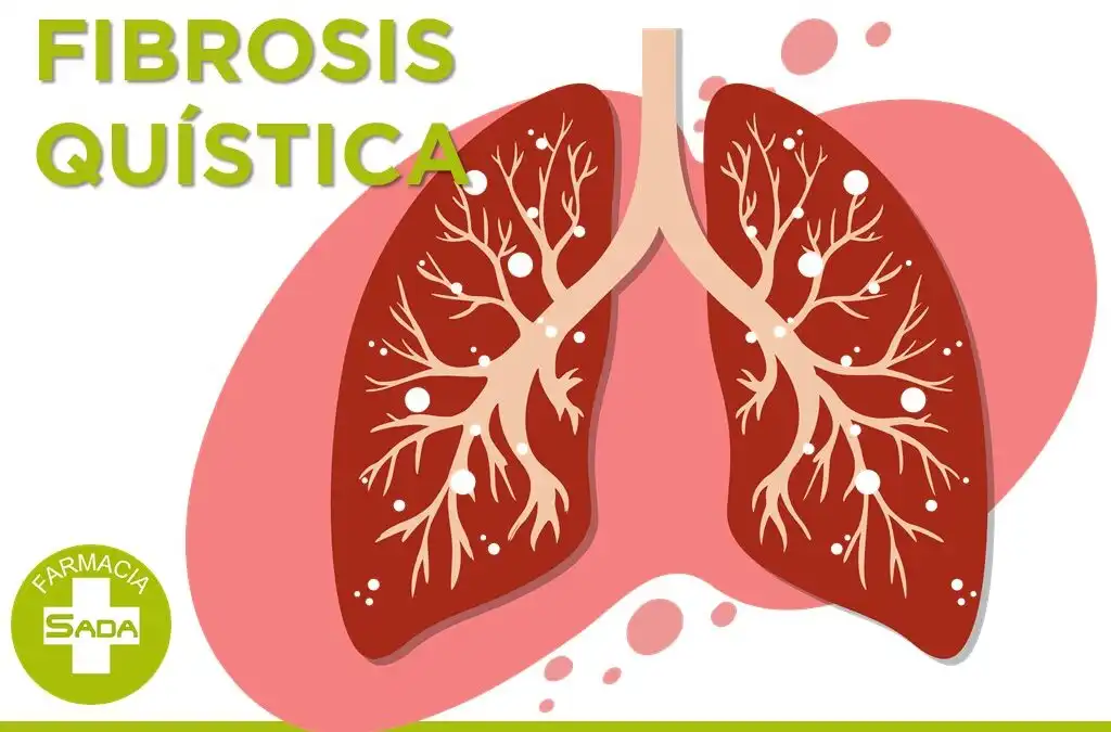 Fibrosis quística en adultos: evolución, tratamientos y desafíos actuales en España
